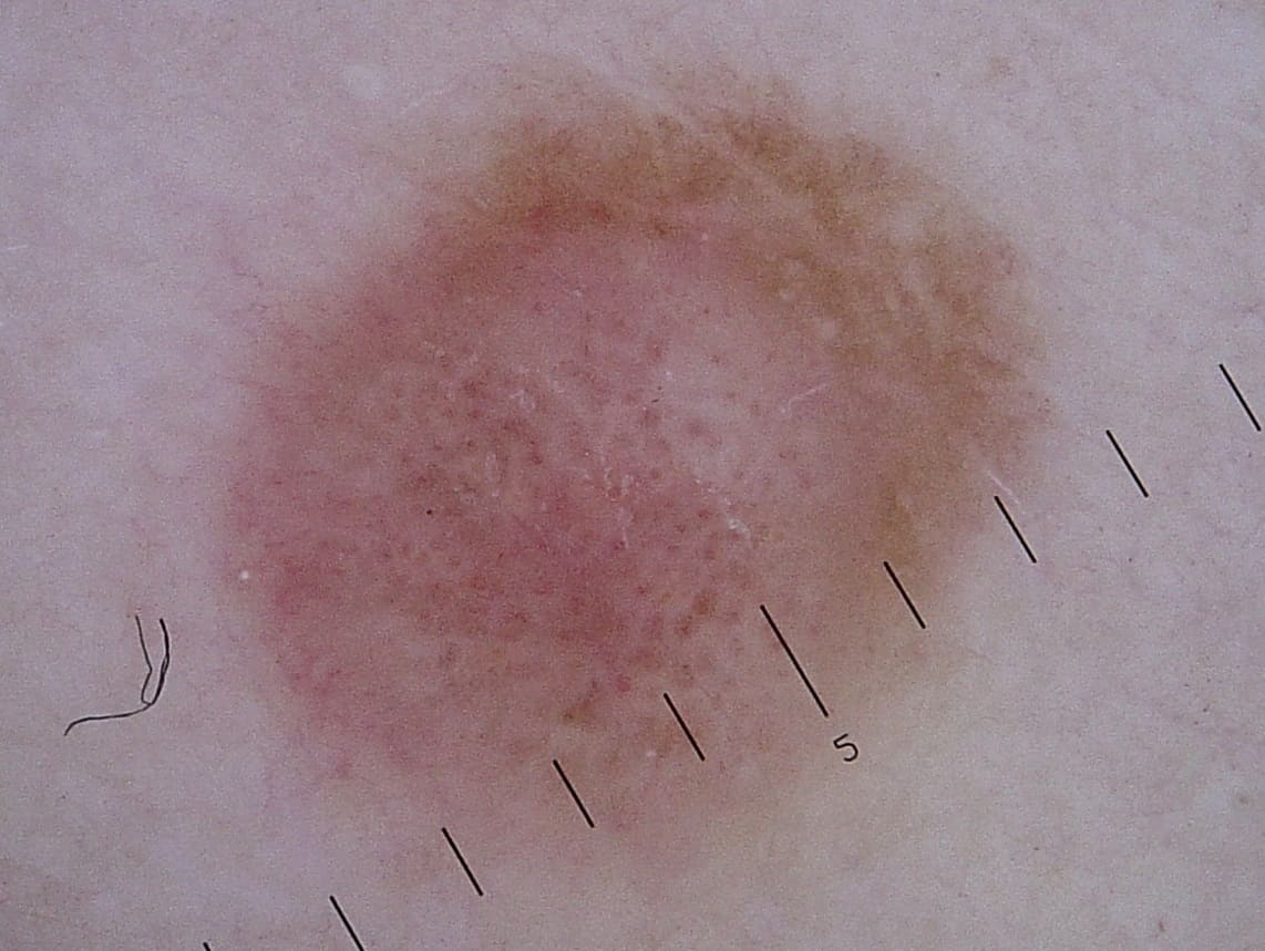 Imagem2-dermatoscopia-figura.jpg
